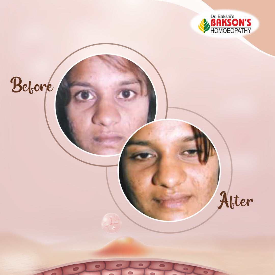 Get Clear Skin with Bakson's Homeopathy Acne Aid Cream, 0.10 kg