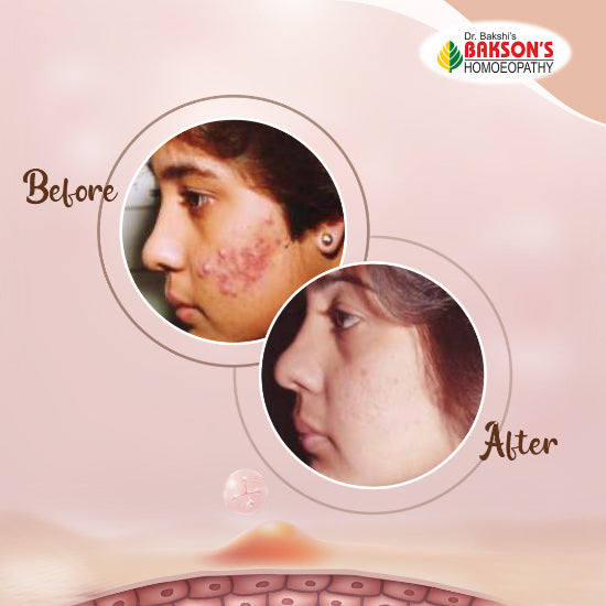 Bakson's Acne Aid Tablets - Homeopathic Solution for Clear Skin, 0.20 kg